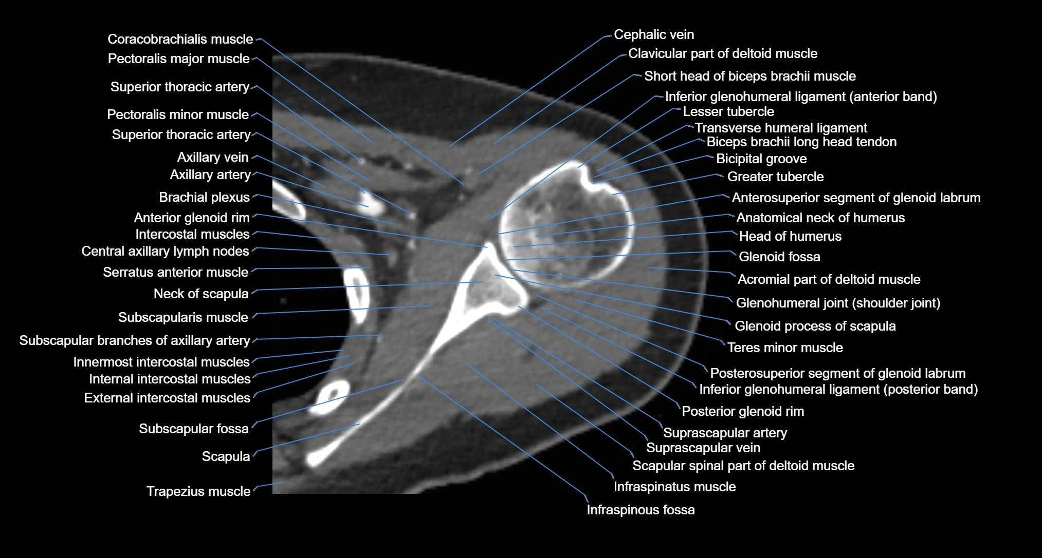 CT Shoulder axial cross sectional anatomy labelled radiology image -00033.webp
